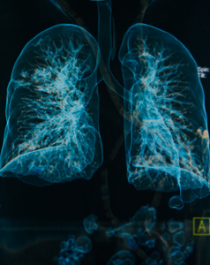 Preview of COPD Collaborative Case Study: Advocate Physician Partners